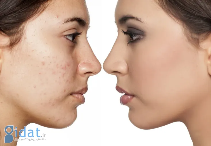 Treatment of boils and scars-3